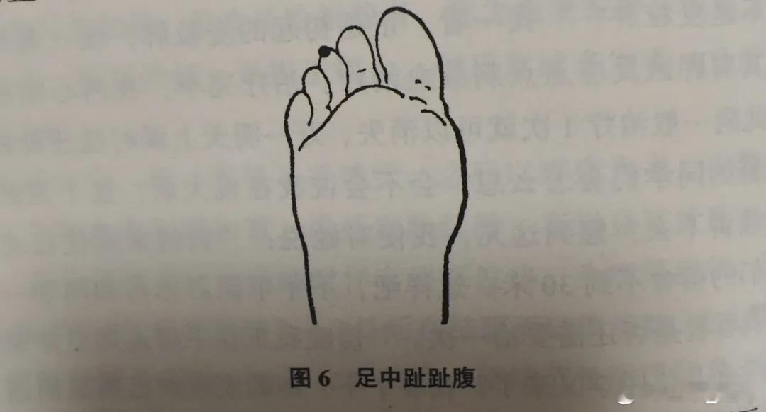 麦粒肿快速治愈《一针疗法》1，上眼睑麦粒肿。上眼睑为膀胱经所过，在背部肩胛区膀胱