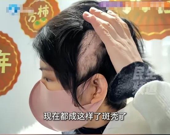 “悲剧还是发生了！”2月23日，河南，一女子在美容院的推销下，往头皮打了玻尿酸，