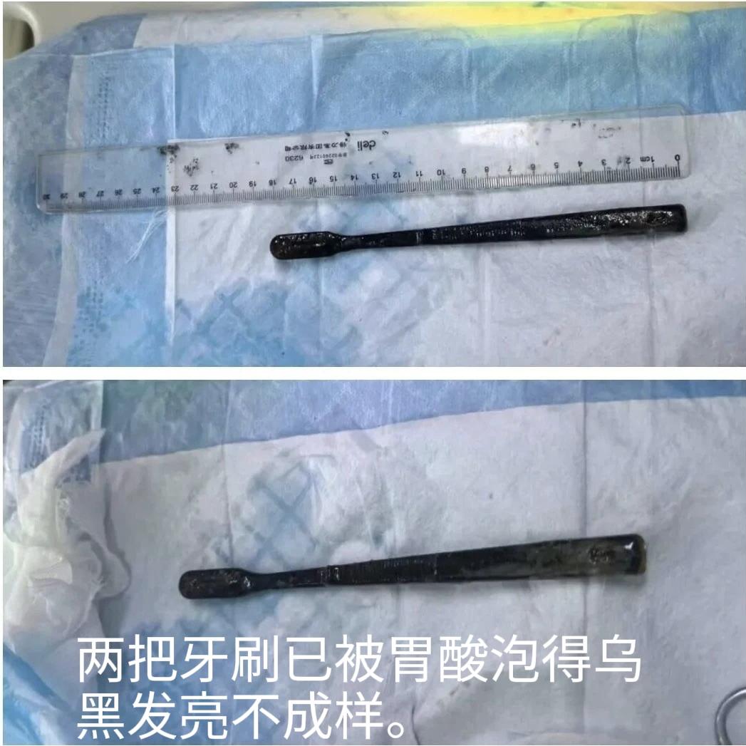 黑龙江，一名男子因为胃痛到医院检查，发现自己的胃里有异物，医生做手术取出来后，发