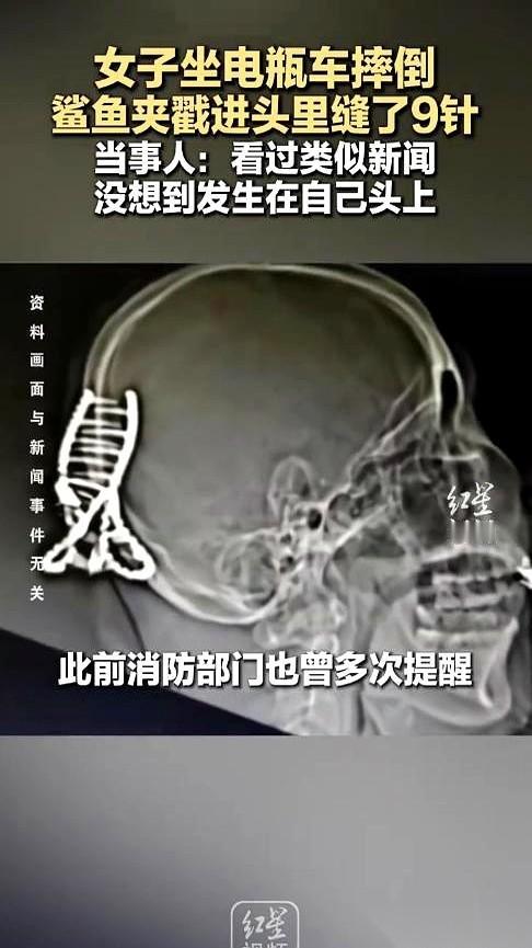 一个发夹，就平时我们最常用的那种鲨鱼夹，直接扎进了后脑勺。血流了一地，送到医院