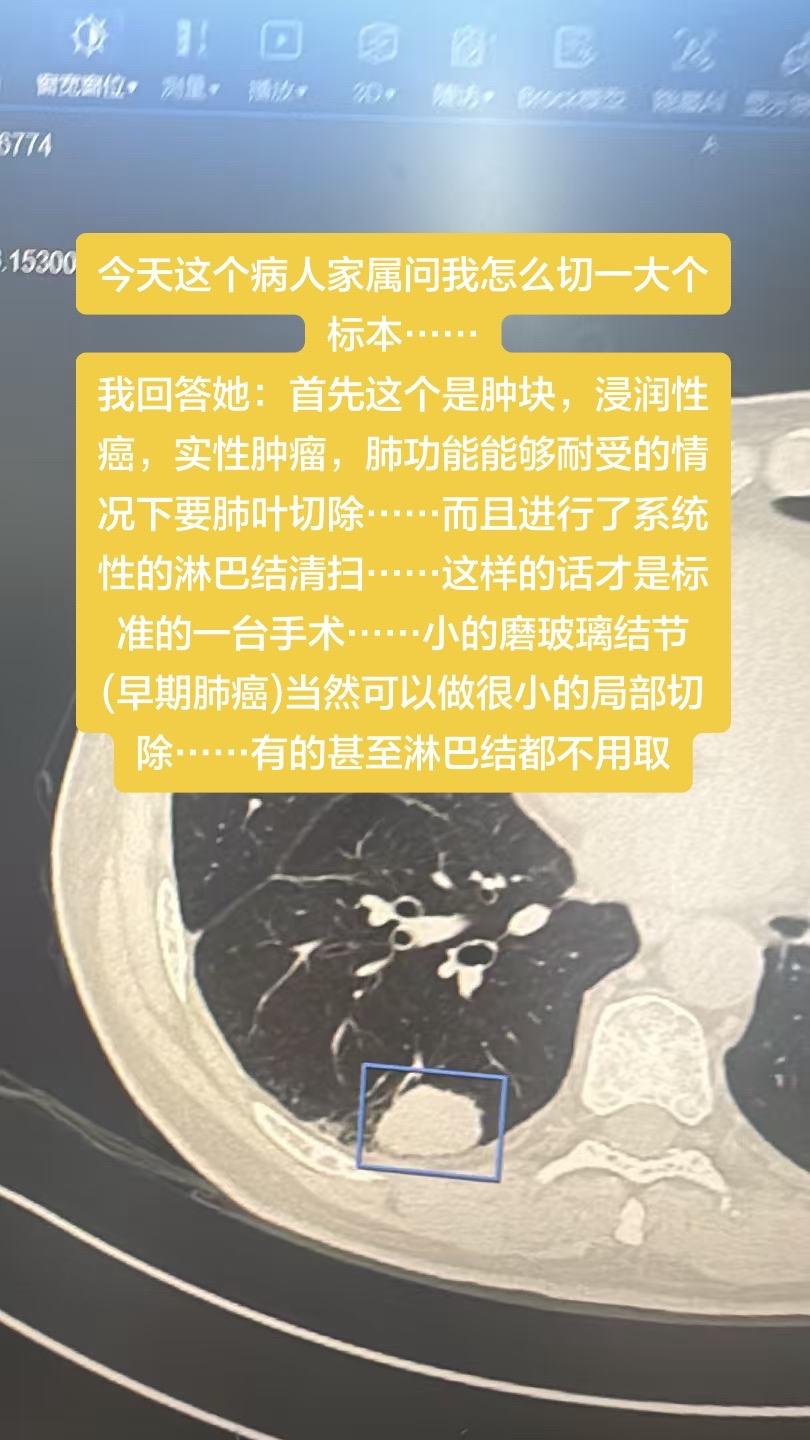 今天这个病人家属问我怎么切一大个标本…… 我回答她：首先这个是肿块，浸...