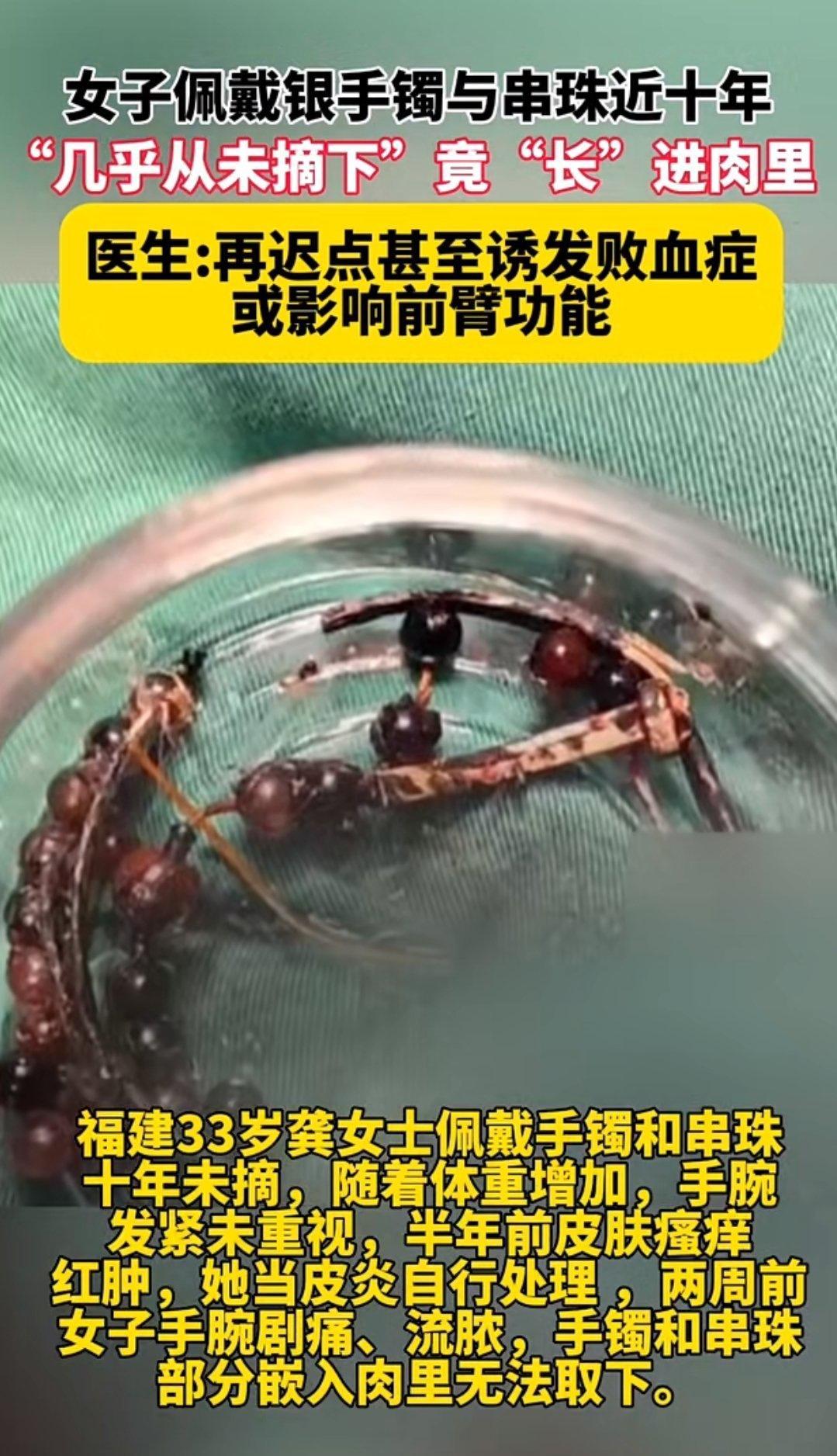 吓出一身冷汗！女子手镯戴10年没摘，竟和肉长在一起差点废了手！福建一位33岁