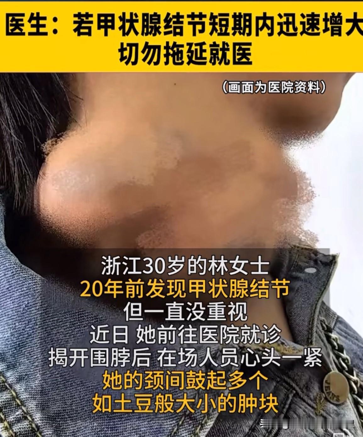 “悲剧还是发生了！”浙江，30多岁女子脖子长出大肿块，像土豆一样的，突出在脖子表