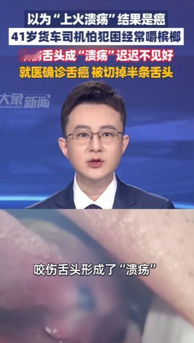 广东深圳，一41岁货车司机长期靠嚼槟榔提神，几个月前咬伤舌头长出一个长久不消的“