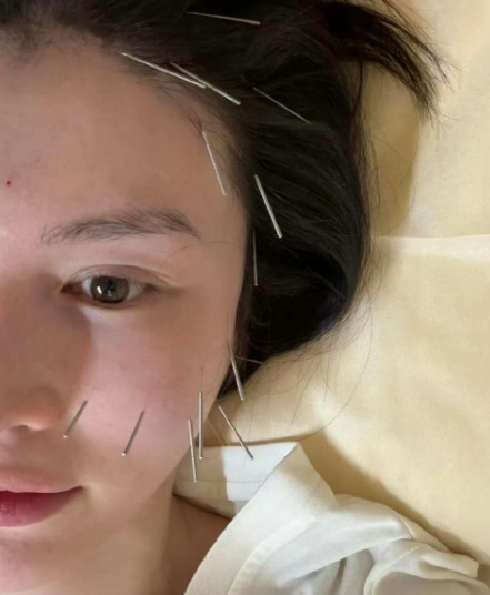 最近大明星何穗做了面部提升针灸，我的妈呀，原来美是要付出很多的，她不是本来就已经