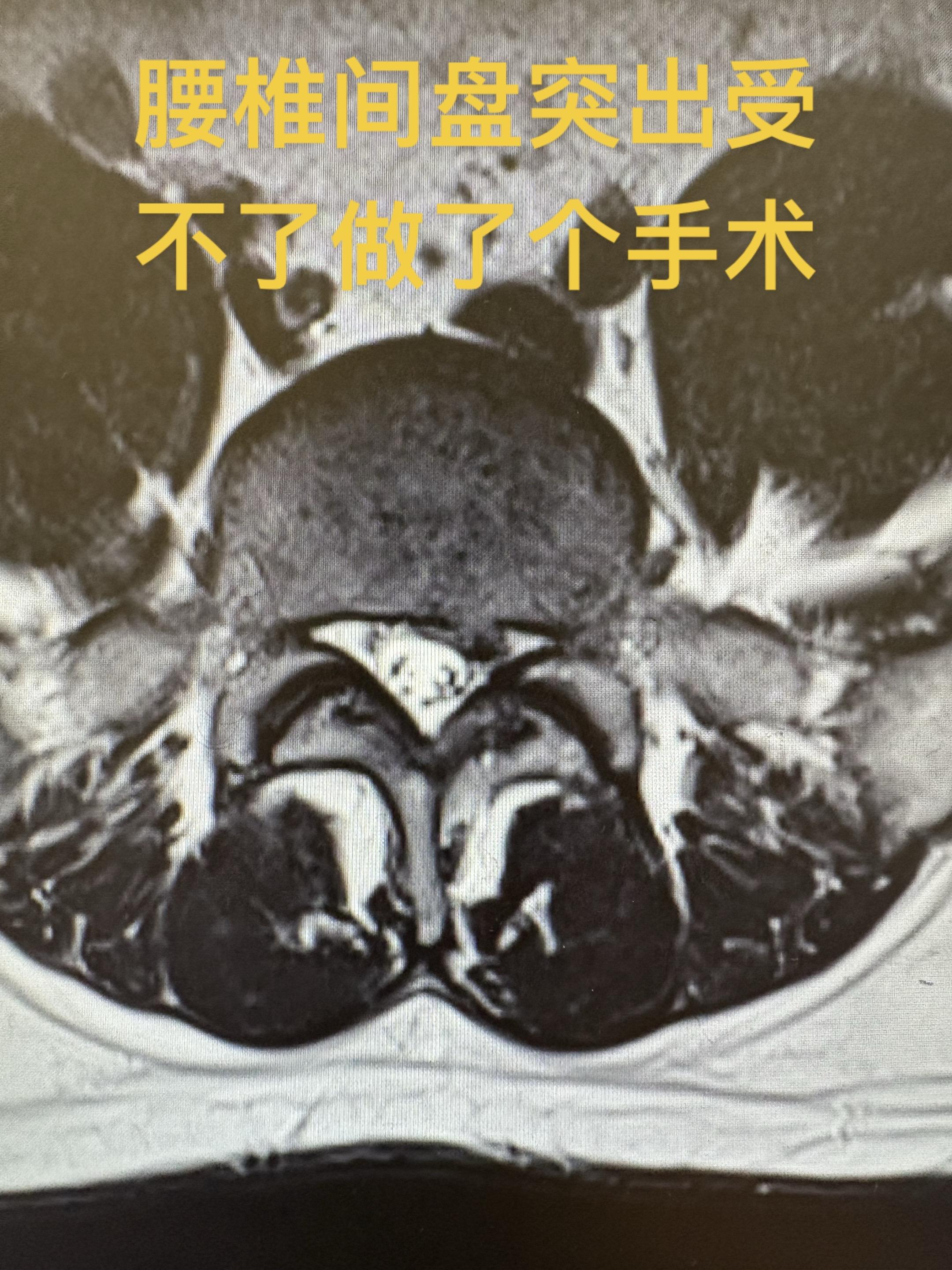 腰椎手术后磁共振报告还有突出。这种情况天塌了吗？其实不然，有文献表明。...