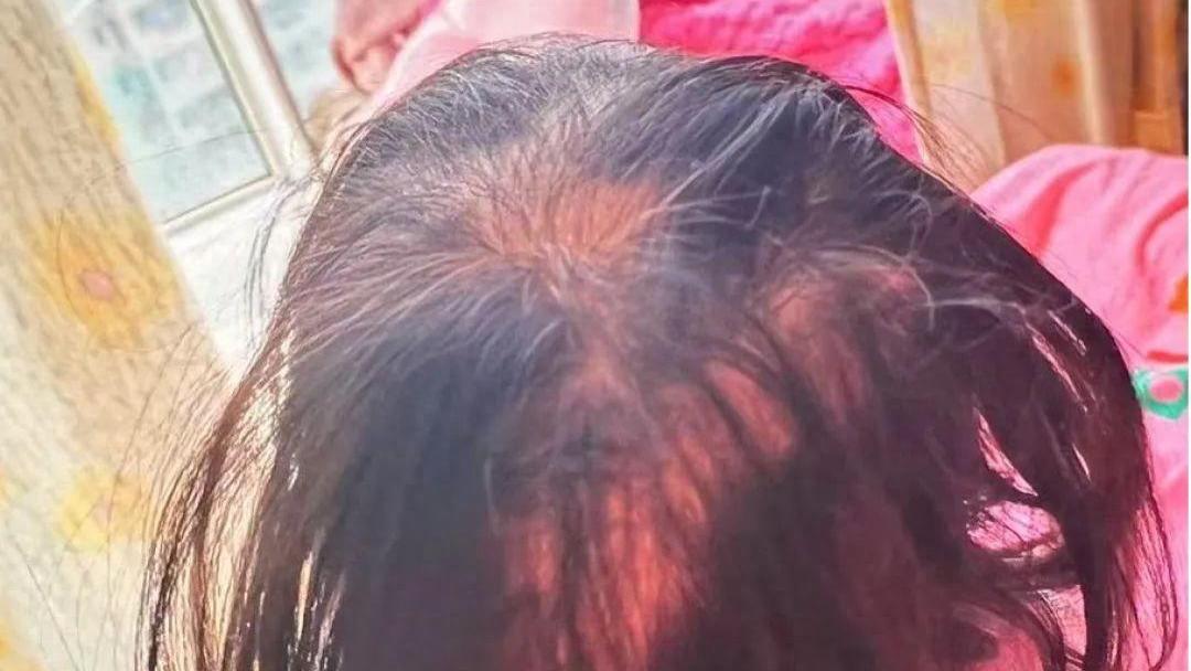 3岁女孩铊中毒,医院独家回应