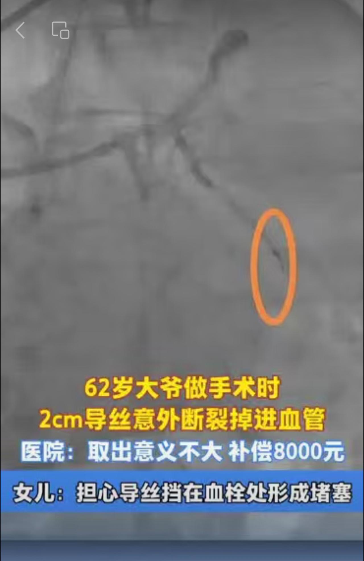 62岁大爷做手术时2cm导丝意外断裂掉进血管，医院称取出意义不大，愿意补偿800