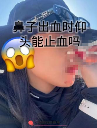 流鼻血时仰头止血居然是错的？几乎每个人小时候流鼻血，都会被身边的长辈按着脑袋