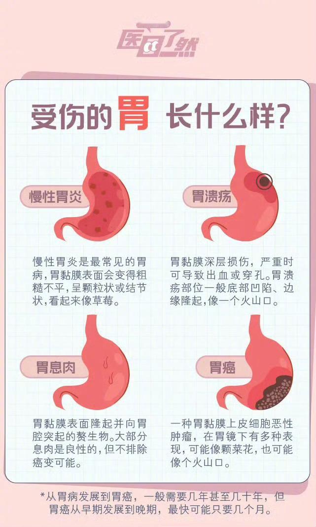 硬核研究所【胃病向胃癌转变的5个危险信号】26岁确诊胃癌前身体发出的信号当代人