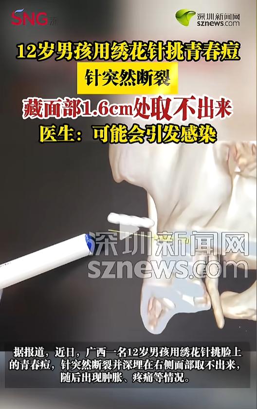 “悲剧还是发生了！”近日，广西，一男孩因为自己脸上长了青春痘，便自己用绣花针给挑