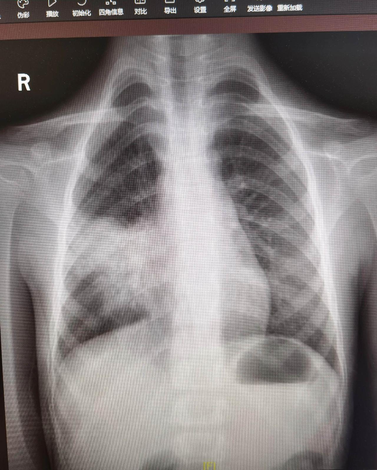 12岁女孩，初中生，间断发热七天。病初高热就确诊流感，吃了奥司他韦有改善，但还没