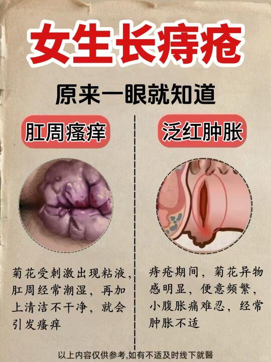 女生长痔疮一眼就看穿！？这些表现要注意～