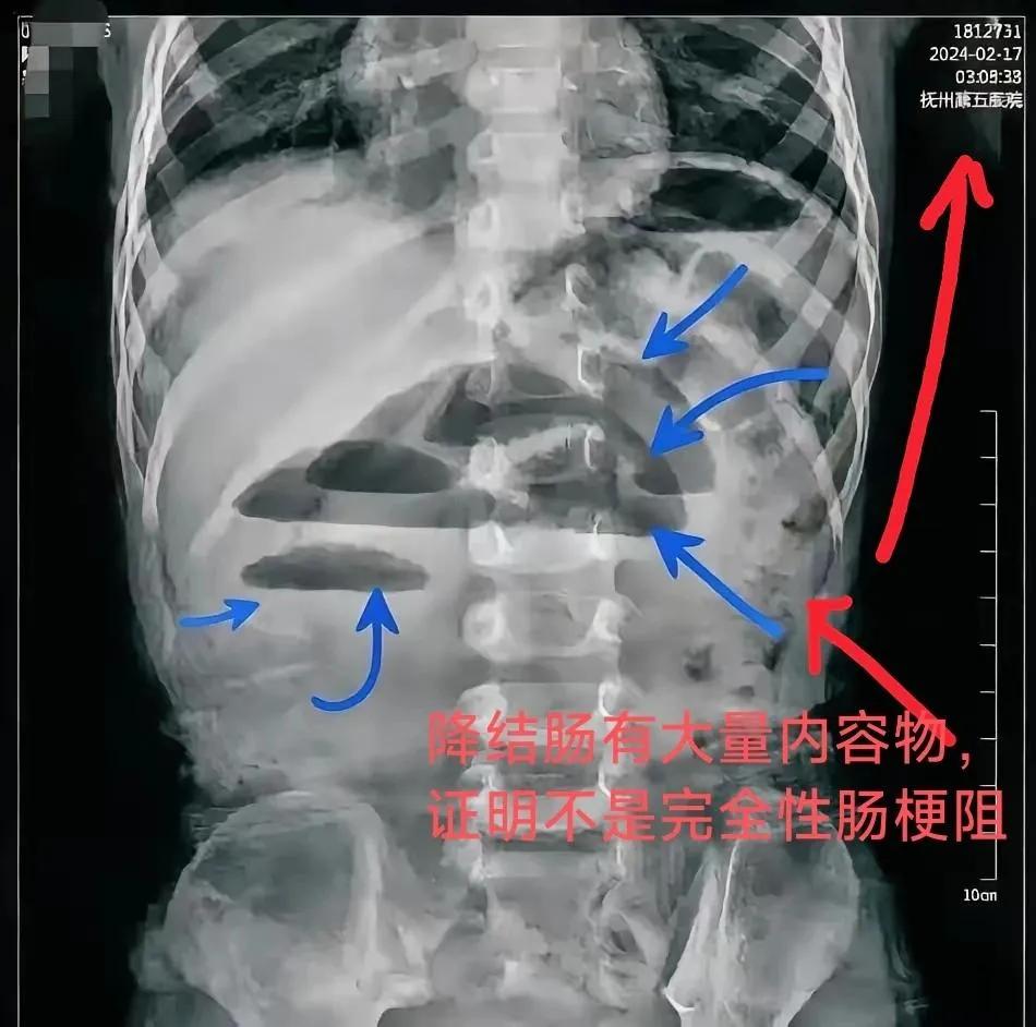 韩杰拒绝了患儿家属立即输液的要求，给患儿拍片。当时腹部立位片解读:液气平面阶梯