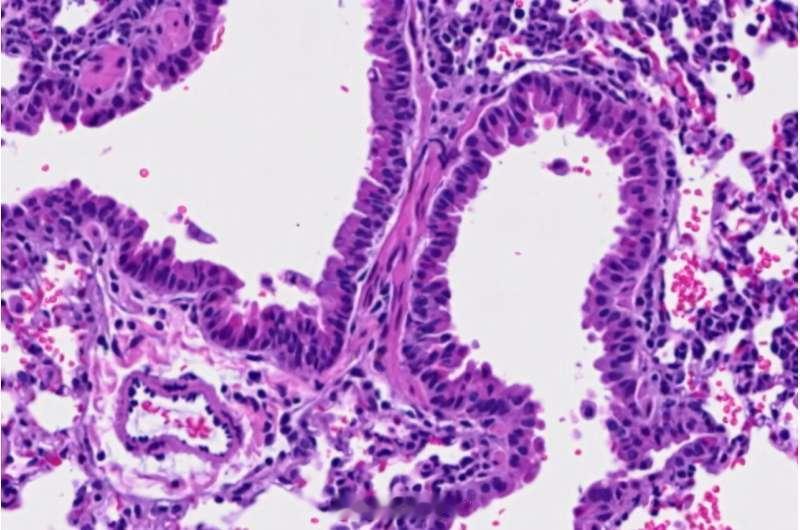 精氨酸可能帮助免疫系统对抗肿瘤和病毒感染这篇MedicalXpress报道介绍