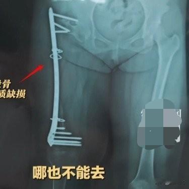 26岁女生植骨4次全溶解!大腿骨头“消失”,刷爆20张卡还要拼第五次河北姑