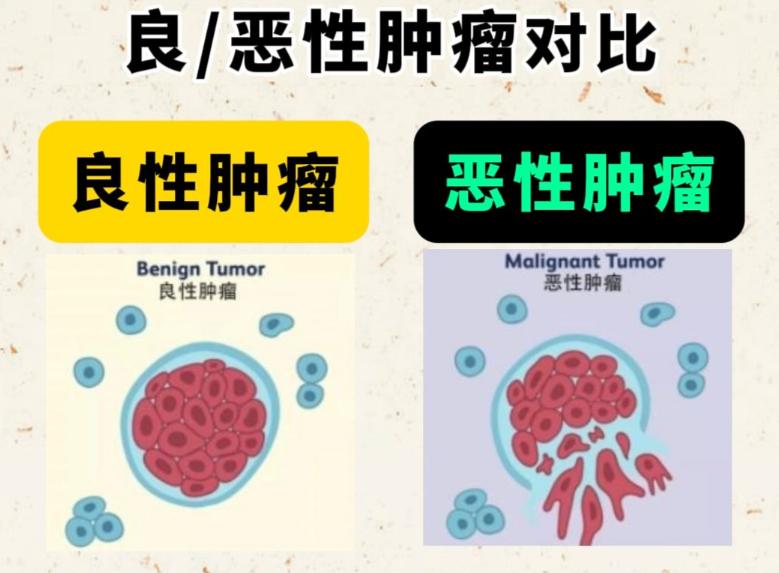 体内有恶性肿瘤的人，身体一般会有7个表现，留心观察老王是个50多岁的出租车