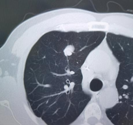 肿瘤最容易转移到肺？这项检查能帮你早发现、早干预！一位40岁左右的年轻男士，几年
