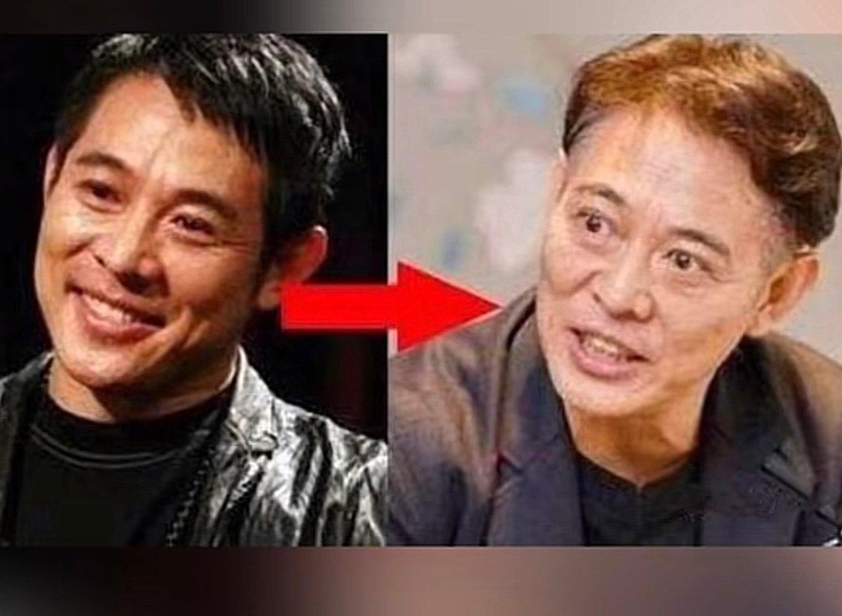 李连杰接受采访时透露甲亢对他的影响很大，患甲亢期间他眼球突出，面部浮肿明显，照镜