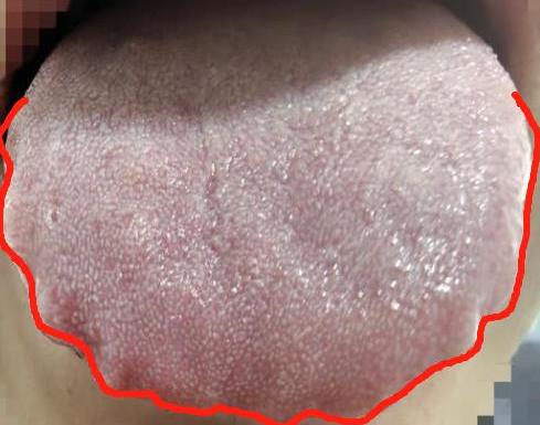 舌胖大+暗紫苔厚腻？这是寒湿裹着瘀血，关节冷痛就因它！大家好，我是中医陈大