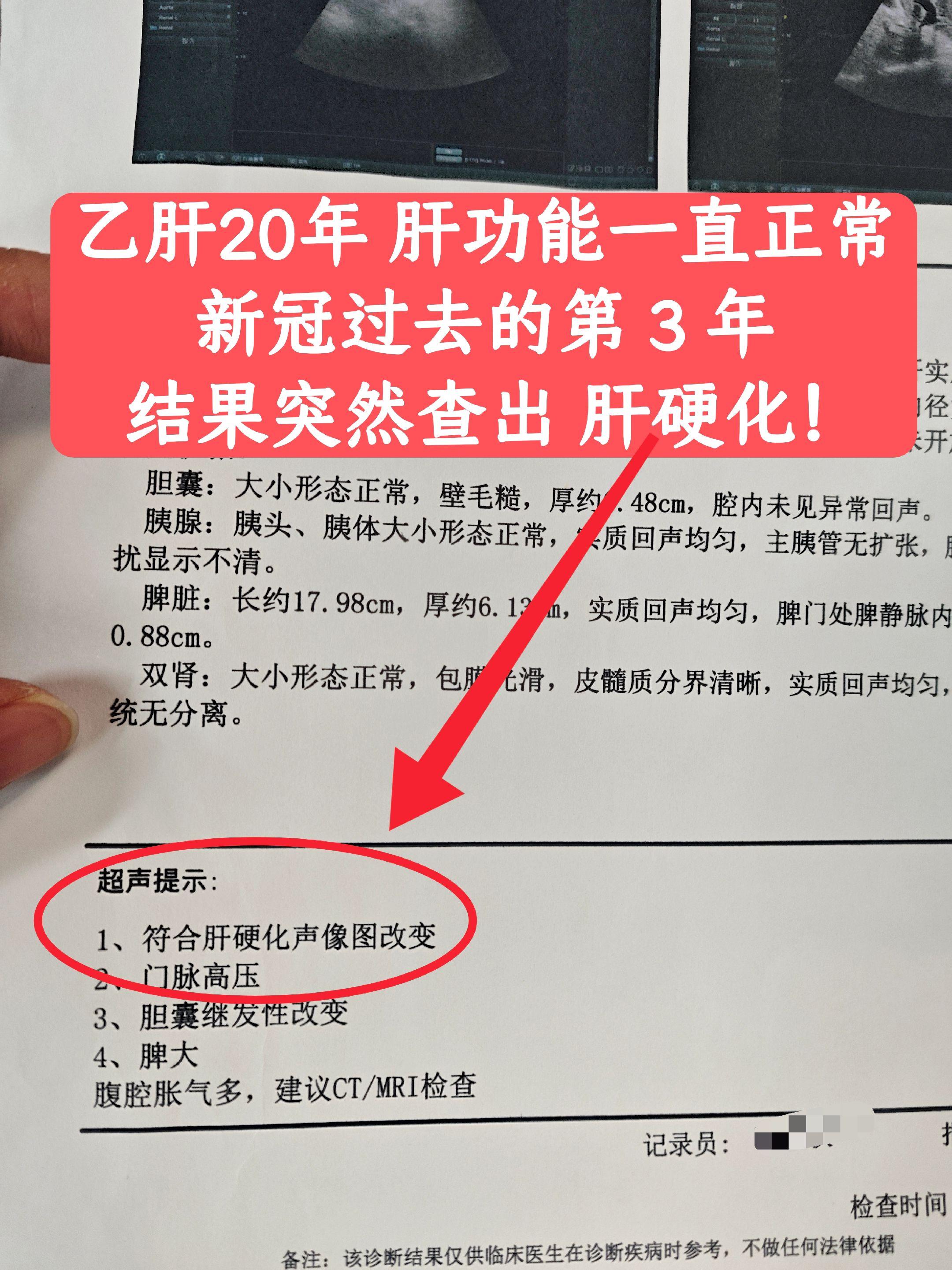 “教授，我乙肝20多年，查过好几次了，肝功能一直都是正常，就疫情那两年...