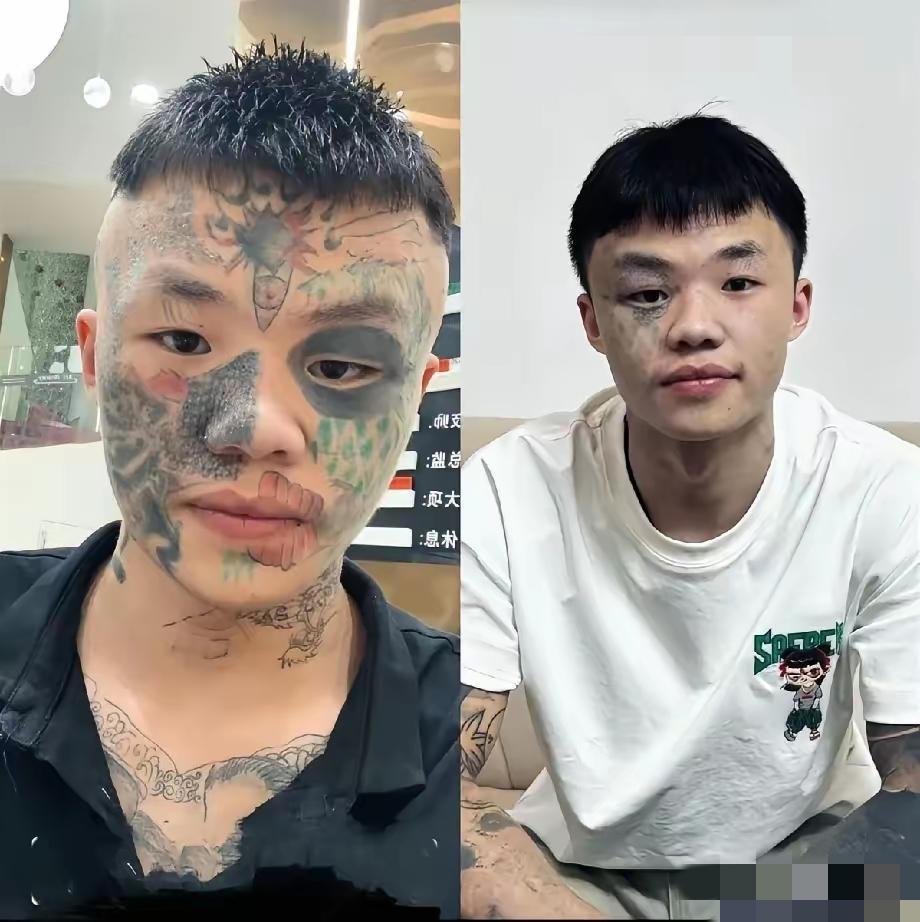广东男孩3次激光洗脸纹身！这哪是洗图案，是在为13岁的冲动还债！夏