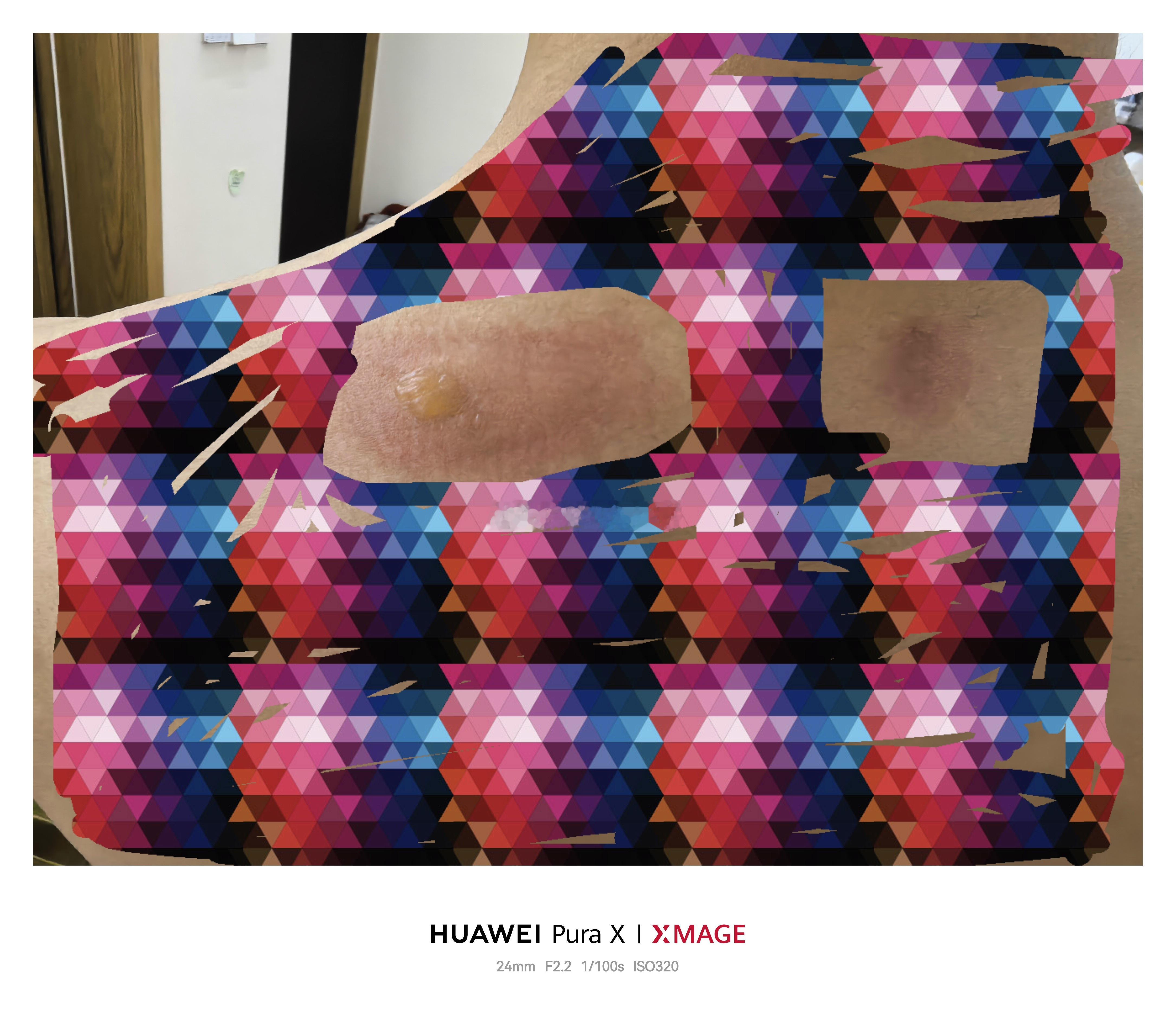 给人当了回工具人展示灸法，结束后颈背部火辣辣得痛，估计被烫伤了，晚上到家发现起泡