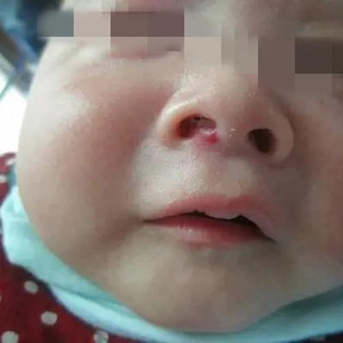 大多数血管瘤发生在宝宝的面部? 导致血管瘤产生的原因是什么?