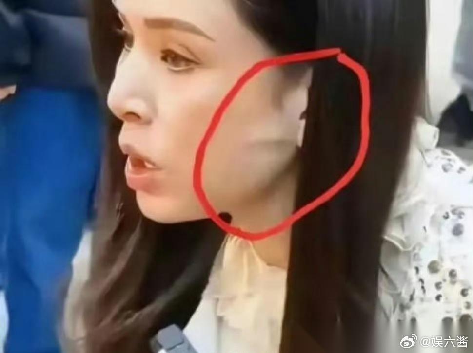 李若彤不是没有医美过吗？这耳前凸起的一条线是啥​​​年纪大了皮肤松弛？​