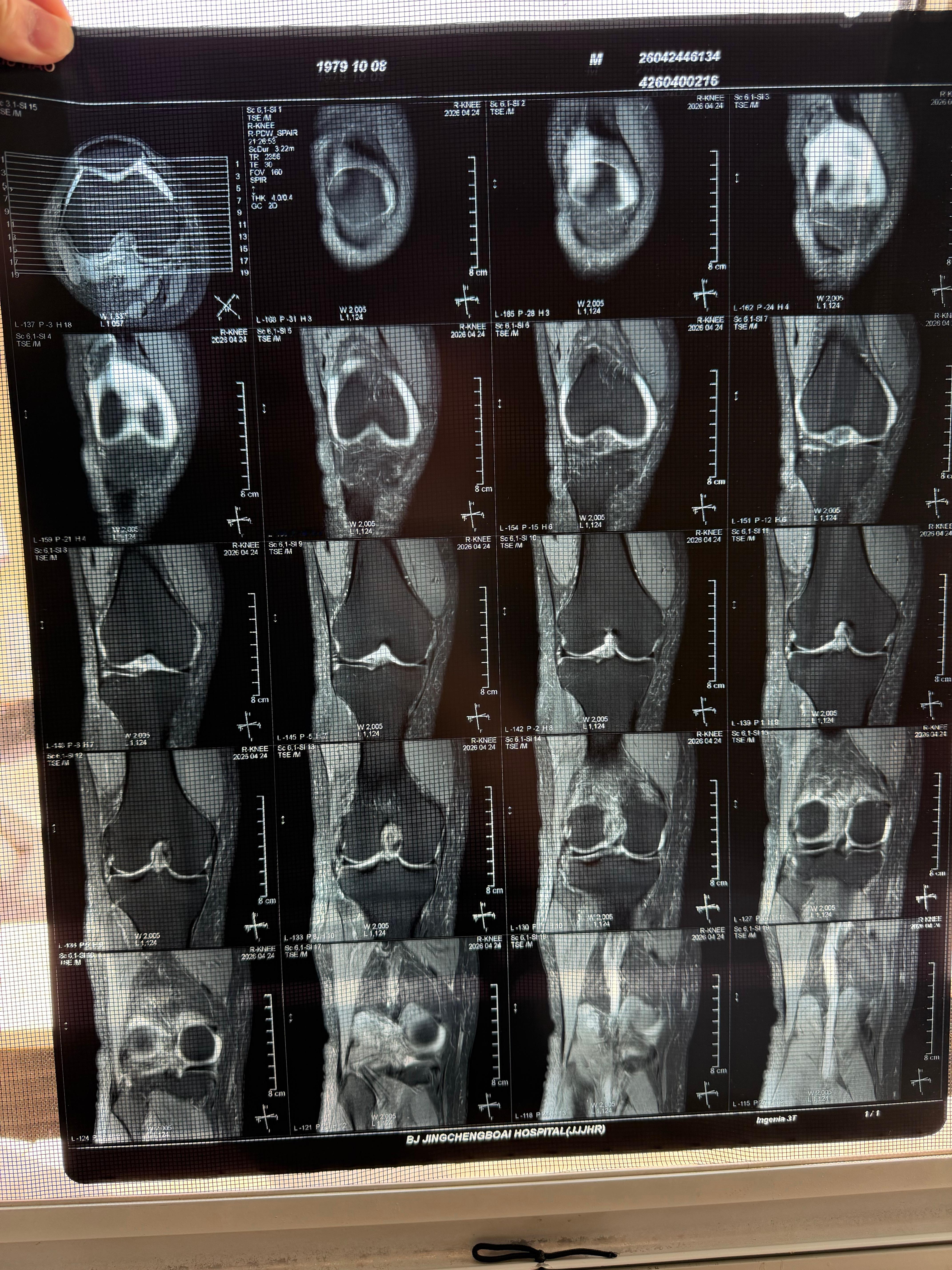 腿疼的厉害，膝关节肿了一大圈。到医院来了，做了cT和核磁，看看医生怎么说。CT