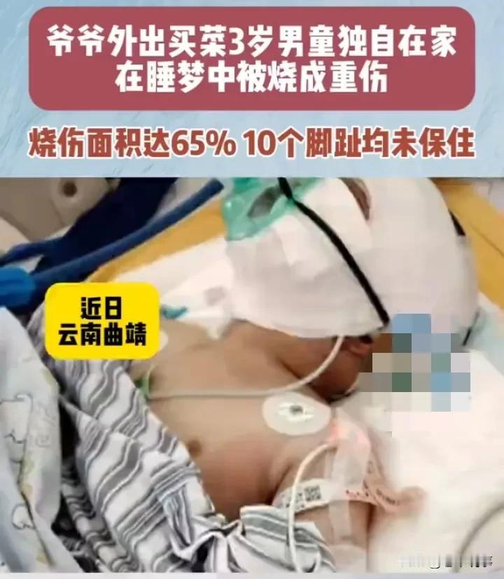 悲剧！3岁男童家中独睡被烧成重伤事情经过：近日，云南曲靖一名3岁男童小钰，在