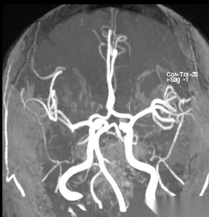 一张“80后”的磁共振血管图。哦不，说错了，是82岁，一个“老”80后。高血