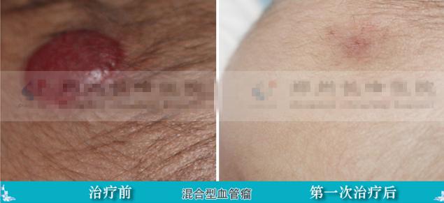 孩子头上有这些症状, 很可能是头部血管瘤!