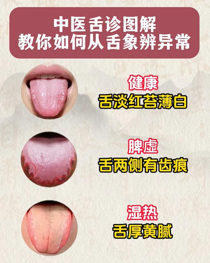 舌有齿痕、裂纹、舌苔发黄？看看属于哪种体质