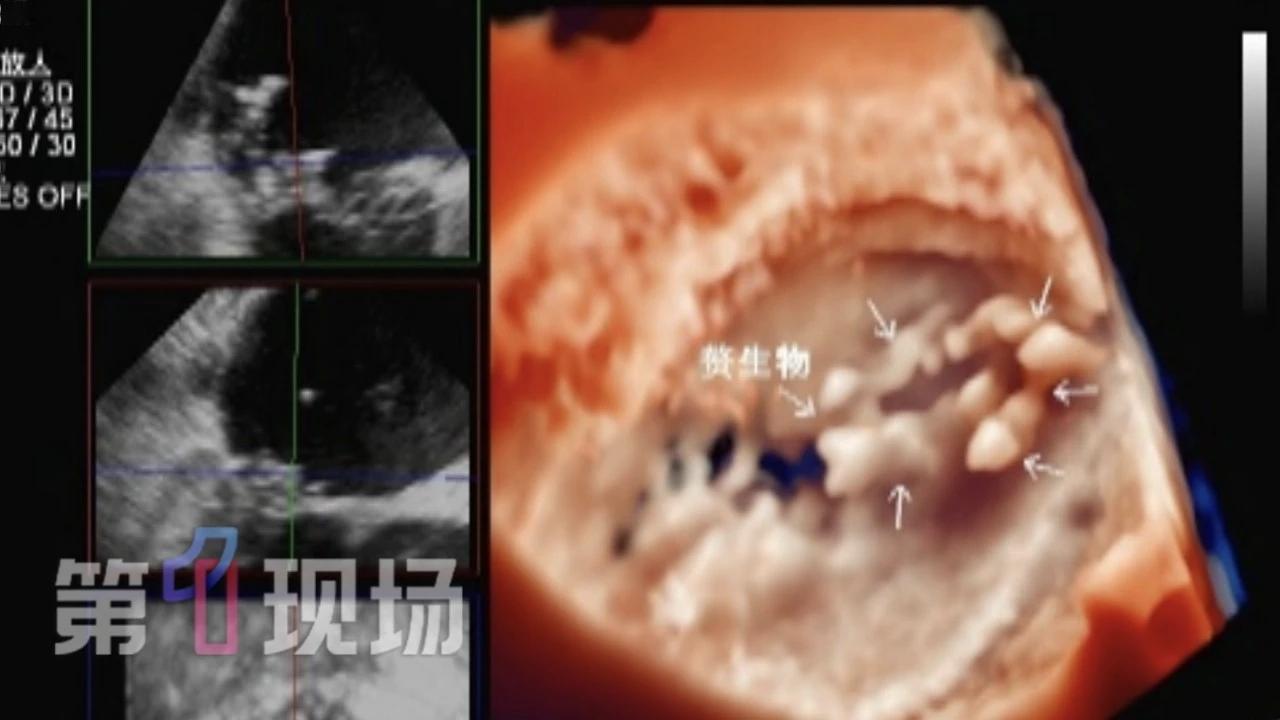 “做梦都想不到发病根源”！深圳51岁的王先生，本来安稳过日子，突然连续3个月一直