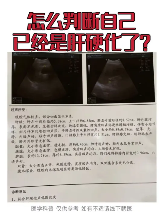 判断是否可能患有肝硬化，可从以下方面初步观察： ①症状表现：身体易疲劳...