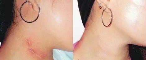 剖腹产疤痕修复