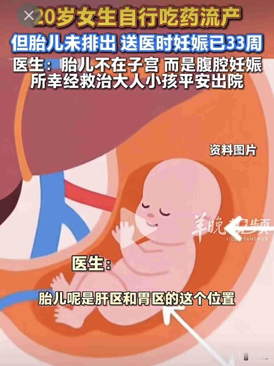 20岁的姑娘自己吃了流产药，以为孩子没了。肚子却越来越大，被强行送医：娃在肚子里