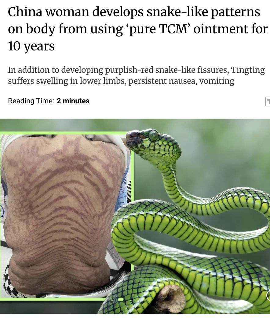外媒：一位中国女性因长期使用一款声称是“纯中药”的药膏，导致全身出现类似蛇皮的紫