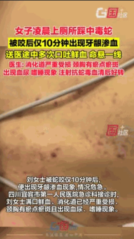 太吓人了！7月1日云南，60岁女子凌晨上厕所踩中毒蛇，仅10分钟后出现牙龈渗血！