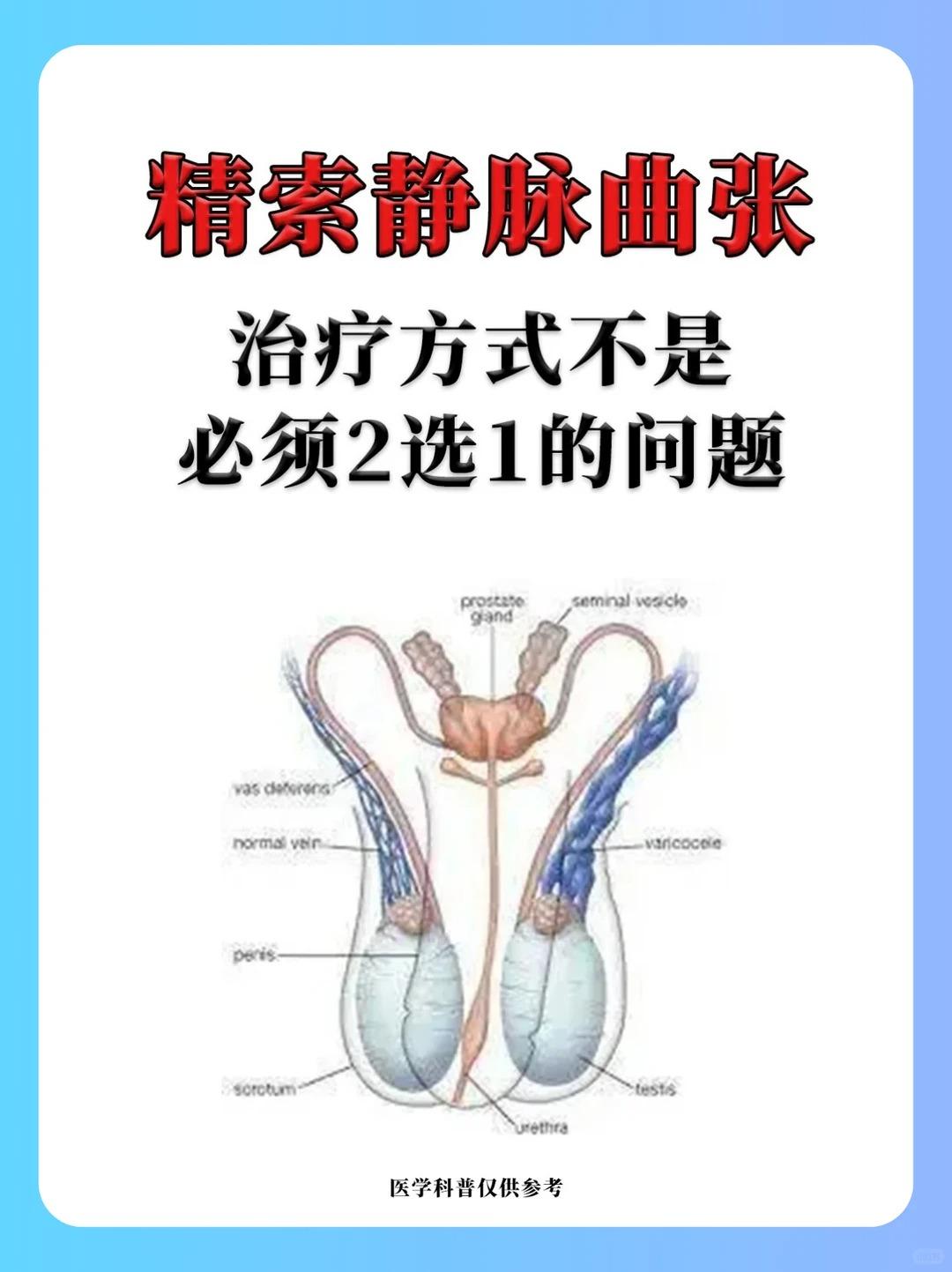 精索静脉曲张的治疗，不是必须2选1的问题关于精索静脉曲张的问题，