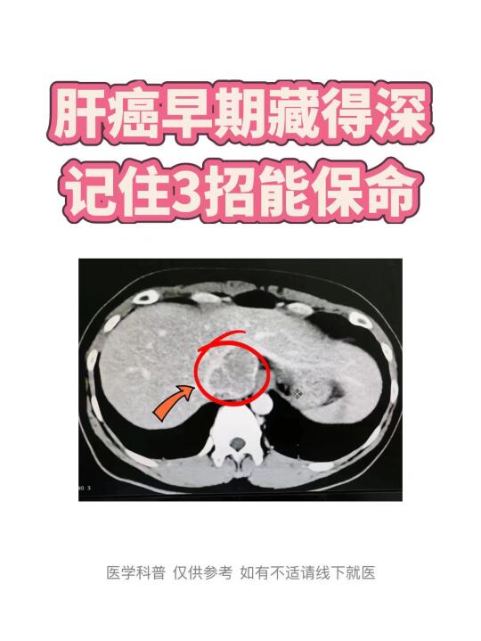 肝癌早期藏得深，记住3招保命： 乙肝/肝硬化患者必查：每3个月...