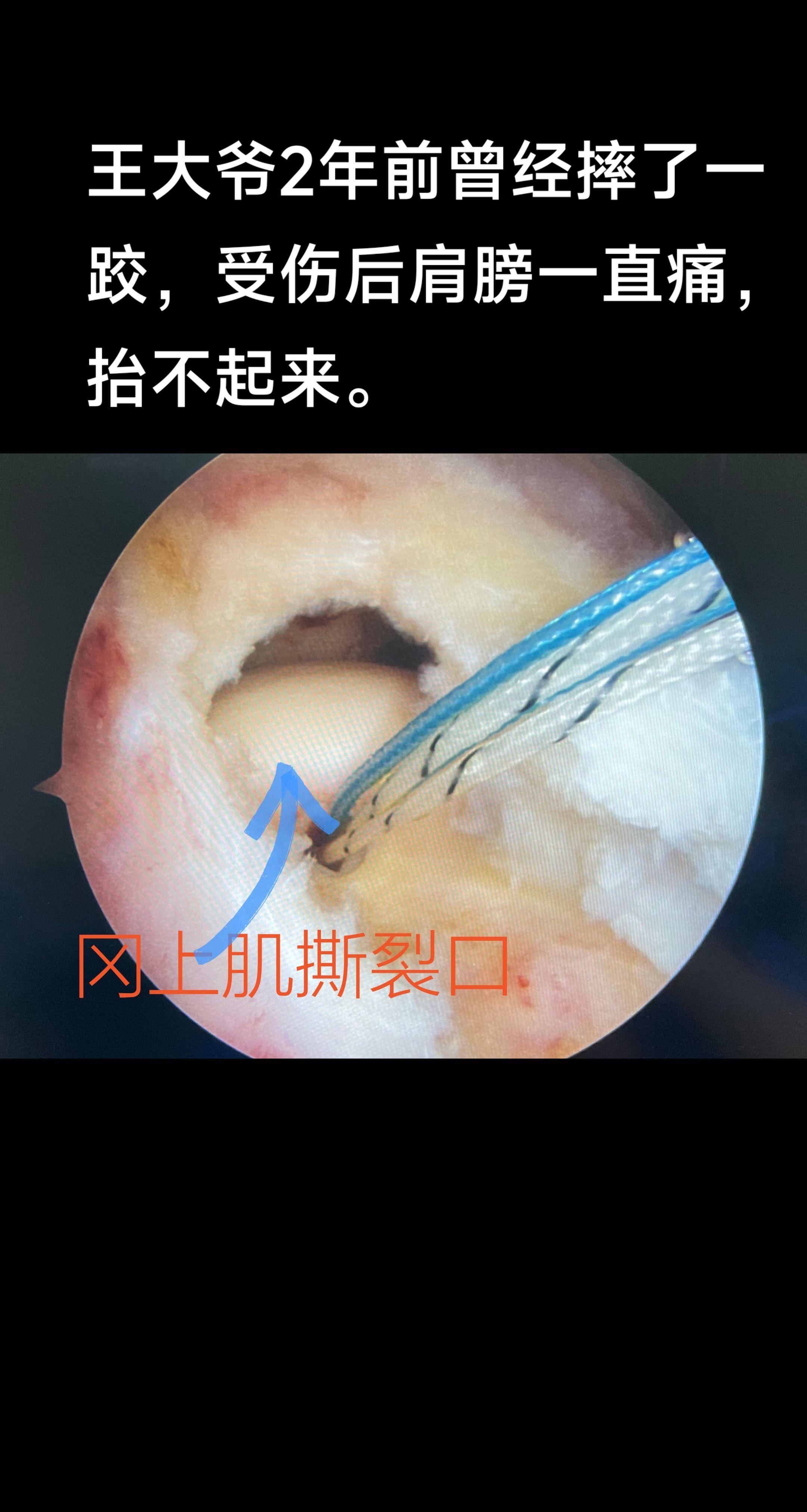 肩袖撕裂。