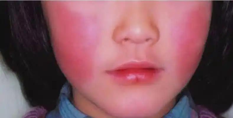 日本“苹果病”流行，国内已有输入病例，主要由病毒引起如何预防日本近期“苹果病”