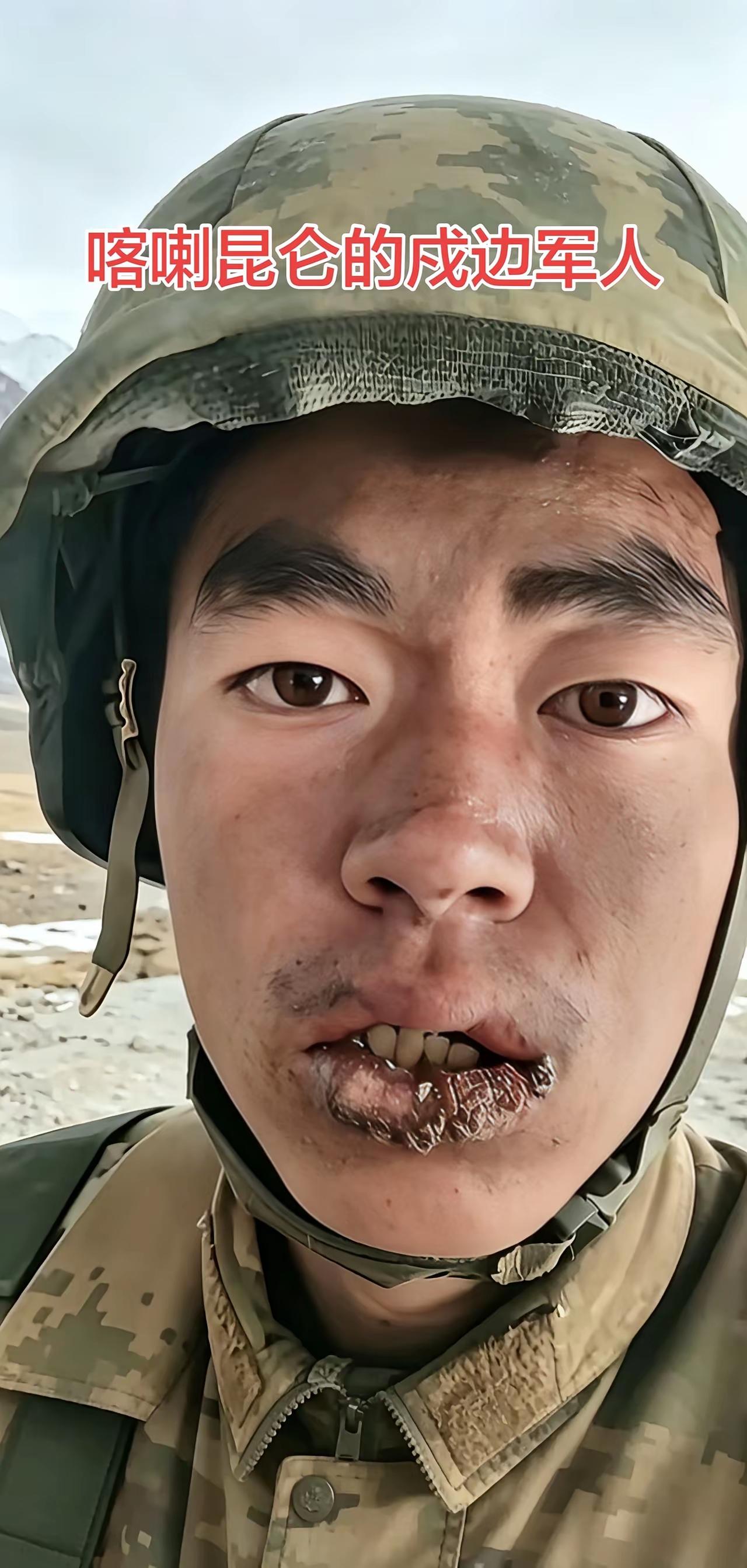 边防战士的嘴唇，隔着屏幕都感觉很疼！不管春夏秋冬，他们都坚守在祖国的边防线上，保