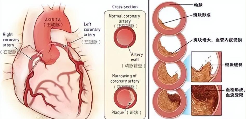 首先就是要把低密度脂蛋白胆固醇至少降低到1.8以下，最好是1.4以下，把低密度脂