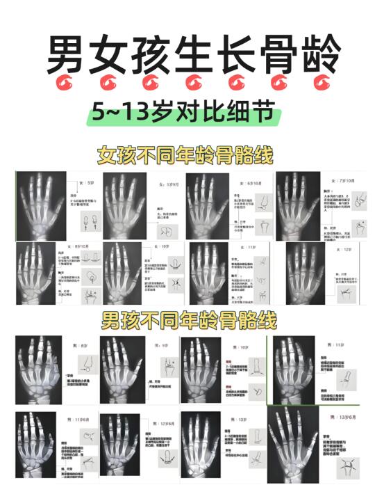 5~13岁孩子骨龄身高对比，新手家长记得看