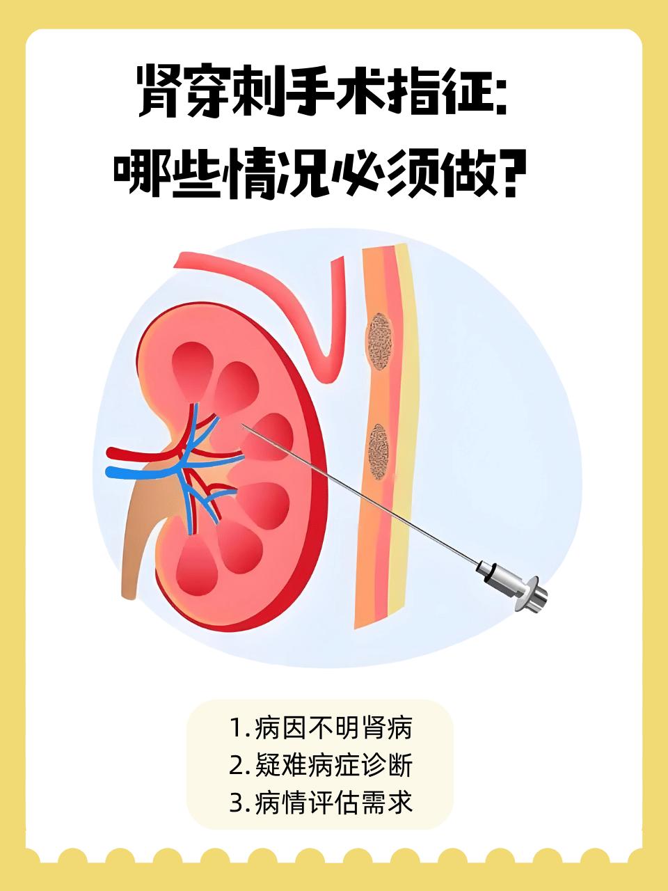 肾穿刺活检：做与不做的利弊总结:一、做肾穿刺（肾活检）的好处1. 精