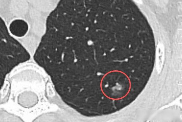 说一个很多人不知道的真相：现在很多人做胸部CT检查，几乎都会查出肺结节。我