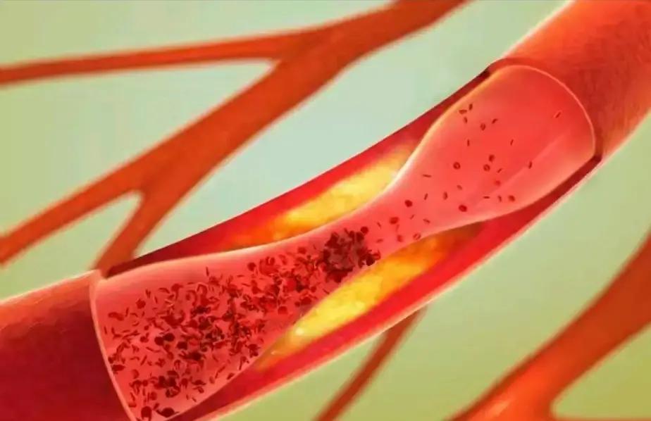 看到老公体检报告上“颈动脉软斑块”这几个字，我腿当时就软了这玩意儿可比硬斑块危